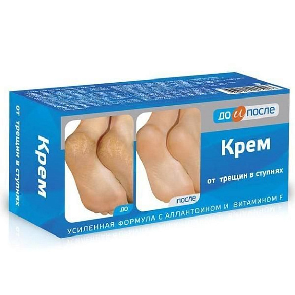 Крем для ног от трещин в ступнях До и После, 150 мл